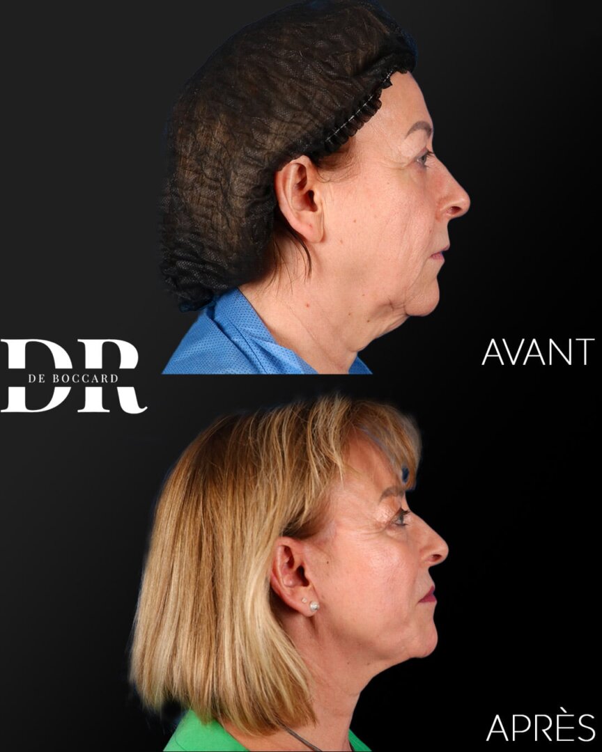 Lifting des sourcils vs reconstruction du front en chirurgie faciale Lifting des sourcils vs reconstruction du front en chirurgie faciale